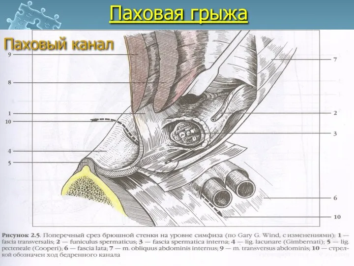 Паховая грыжа Паховый канал