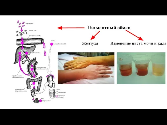 Желтуха Пигментный обмен Изменение цвета мочи и кала