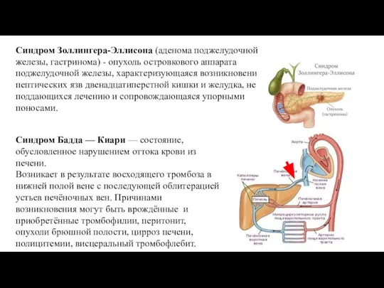 Cиндром Золлингера-Эллисона (аденома поджелудочной железы, гастринома) - опухоль островкового аппарата поджелудочной железы,