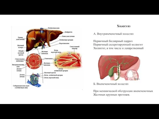 Холестаз А. Внутрипеченочный холестаз Первичный билиарный цирроз Первичный склерозирующий холангит Холангит, в