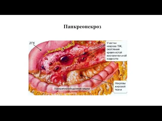 Панкреонекроз