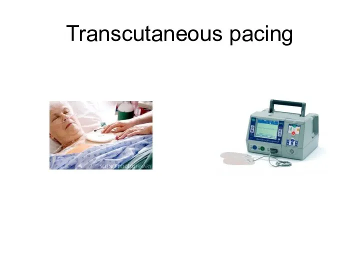 Transcutaneous pacing