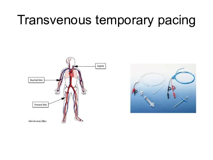 Transvenous temporary pacing
