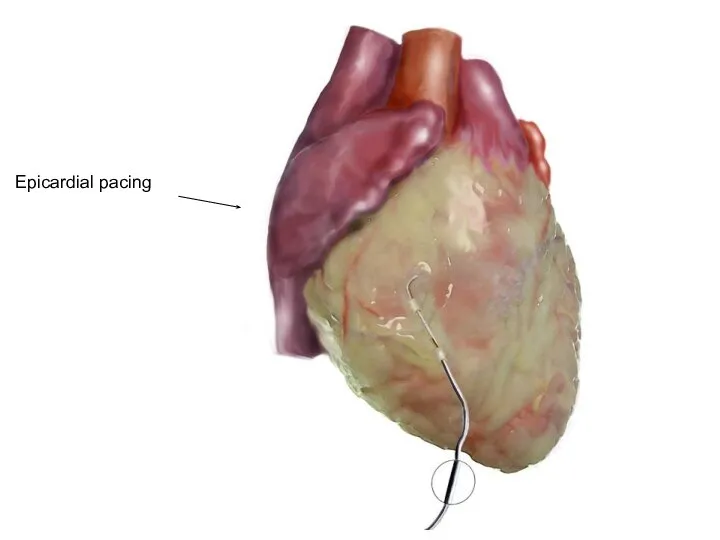 Epicardial pacing