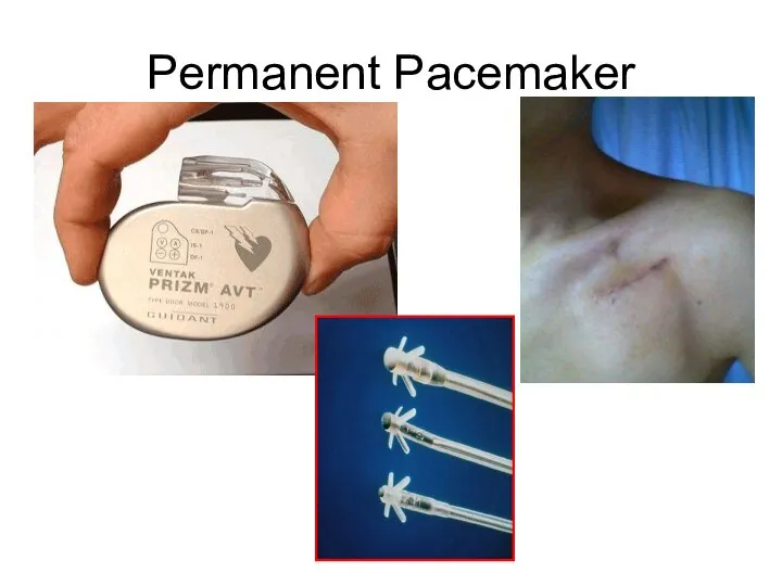Permanent Pacemaker