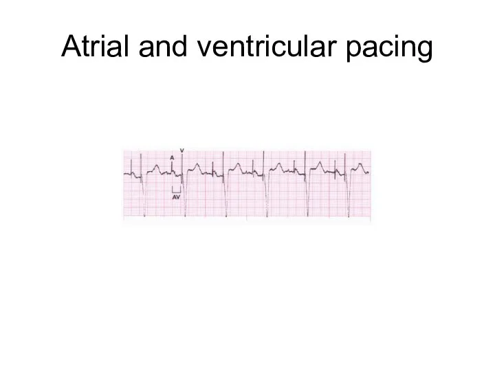 Atrial and ventricular pacing