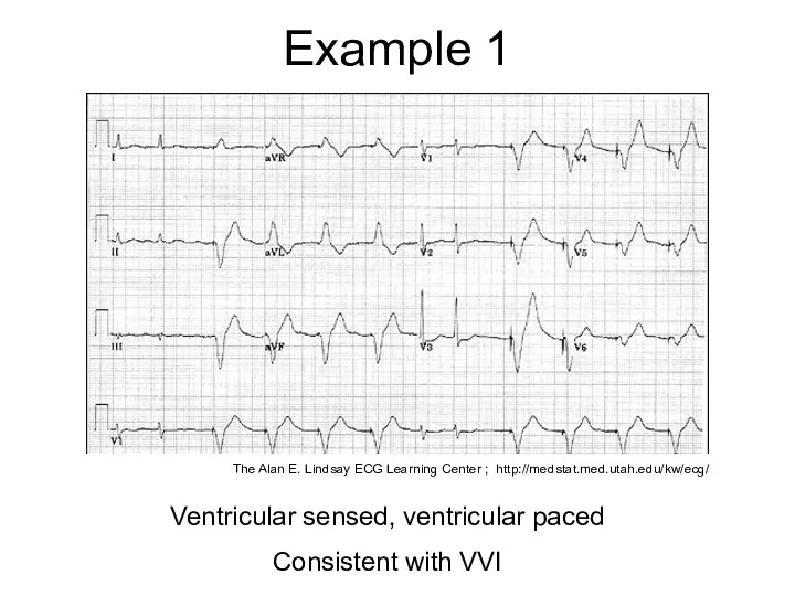 Example 1 Ventricular sensed, ventricular paced Consistent with VVI The Alan E.