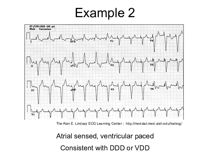 Example 2 Atrial sensed, ventricular paced Consistent with DDD or VDD The