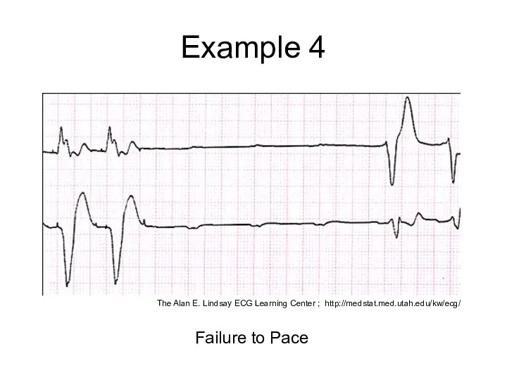 Example 4 Failure to Pace The Alan E. Lindsay ECG Learning Center ; http://medstat.med.utah.edu/kw/ecg/