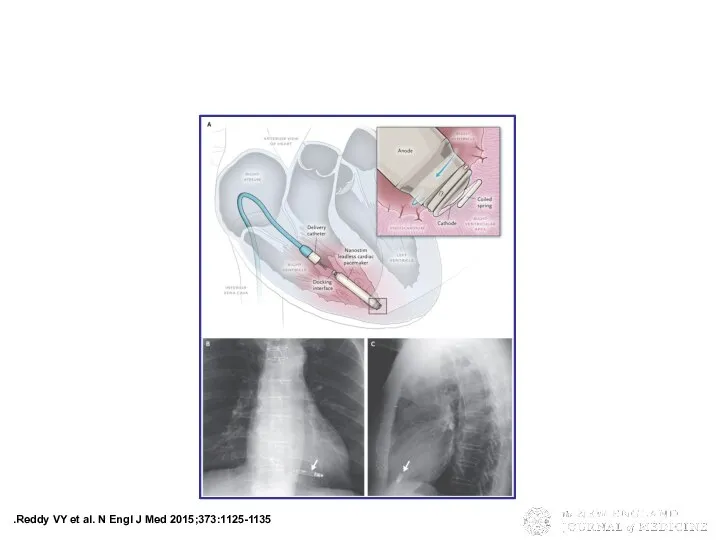 Reddy VY et al. N Engl J Med 2015;373:1125-1135. The Leadless LPacemaker.