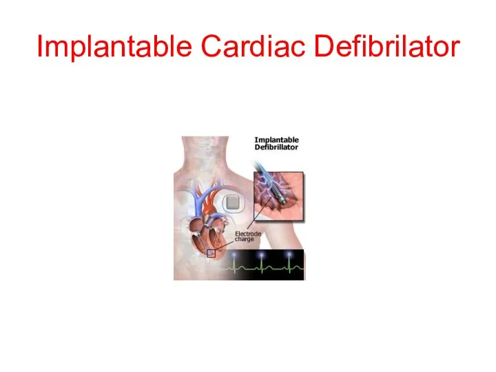 Implantable Cardiac Defibrilator