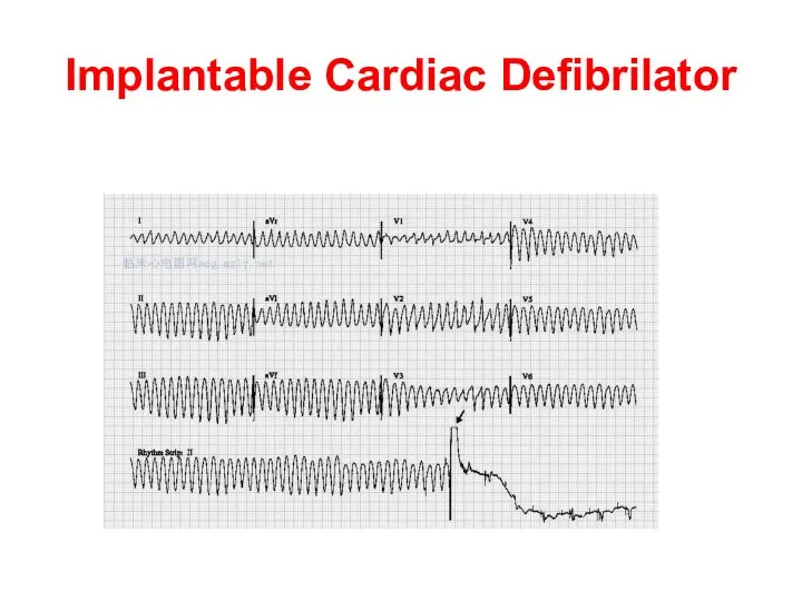 Implantable Cardiac Defibrilator