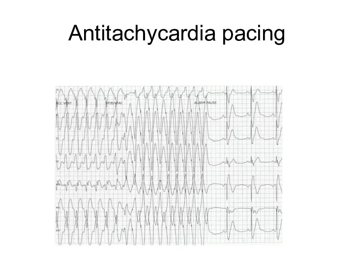 Antitachycardia pacing