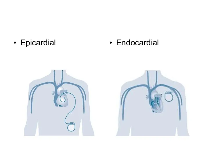 Epicardial Endocardial