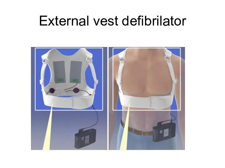 External vest defibrilator