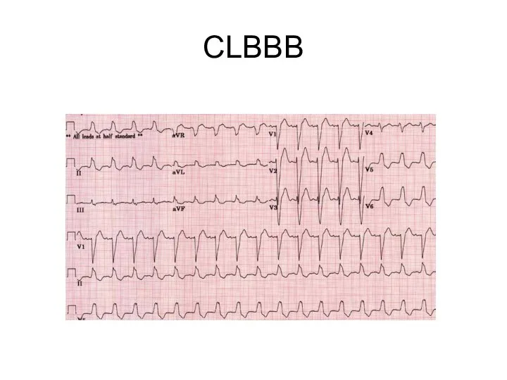 CLBBB