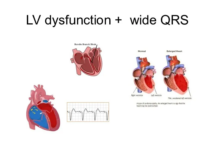 LV dysfunction + wide QRS