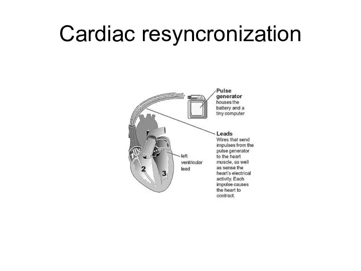 Cardiac resyncronization