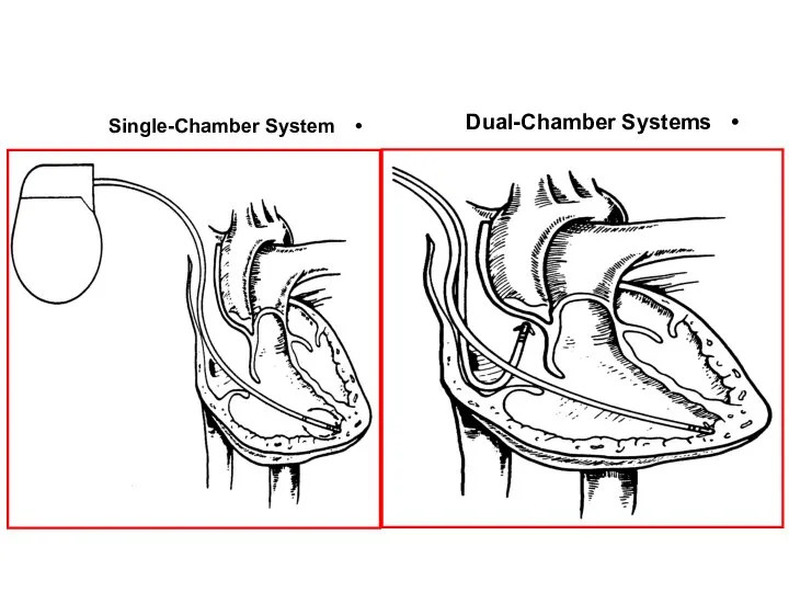 Single-Chamber System Dual-Chamber Systems