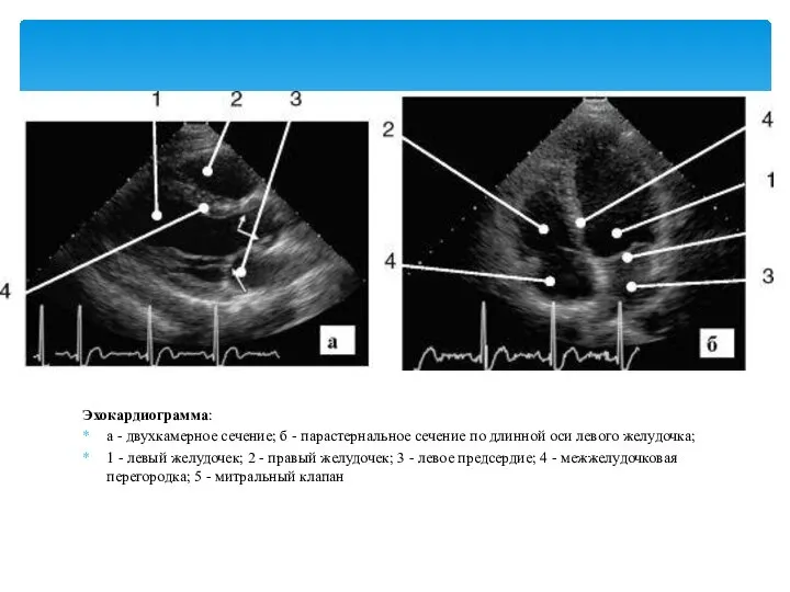 Эхокардиограмма: а - двухкамерное сечение; б - парастернальное сечение по длинной оси