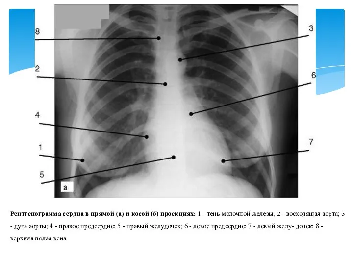 Рентгенограмма сердца в прямой (а) и косой (б) проекциях: 1 - тень