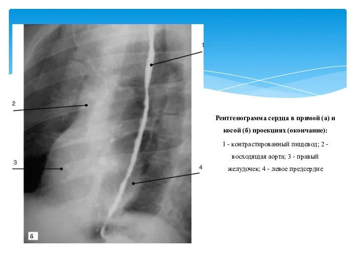 Рентгенограмма сердца в прямой (а) и косой (б) проекциях (окончание): 1 -