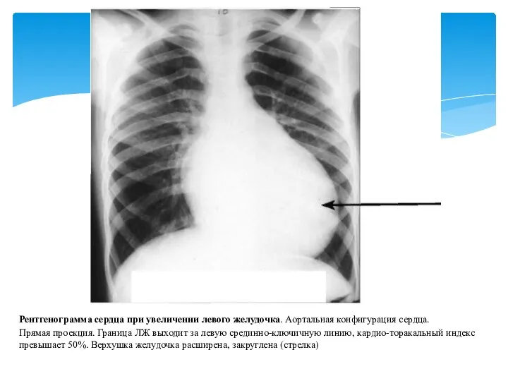 Рентгенограмма сердца при увеличении левого желудочка. Аортальная конфигурация сердца. Прямая проекция. Граница