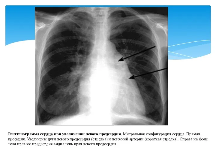 Рентгенограмма сердца при увеличении левого предсердия. Митральная конфигурация сердца. Прямая проекция. Увеличены