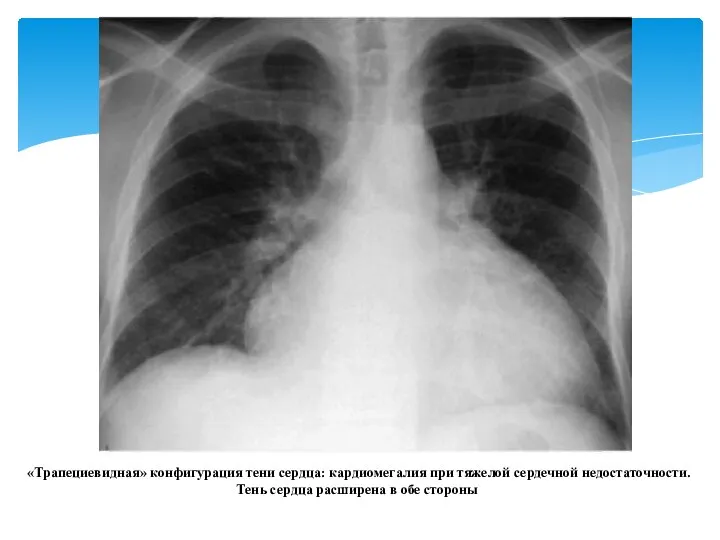 «Трапециевидная» конфигурация тени сердца: кардиомегалия при тяжелой сердечной недостаточности. Тень сердца расширена в обе стороны