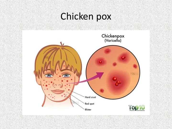 Chicken pox