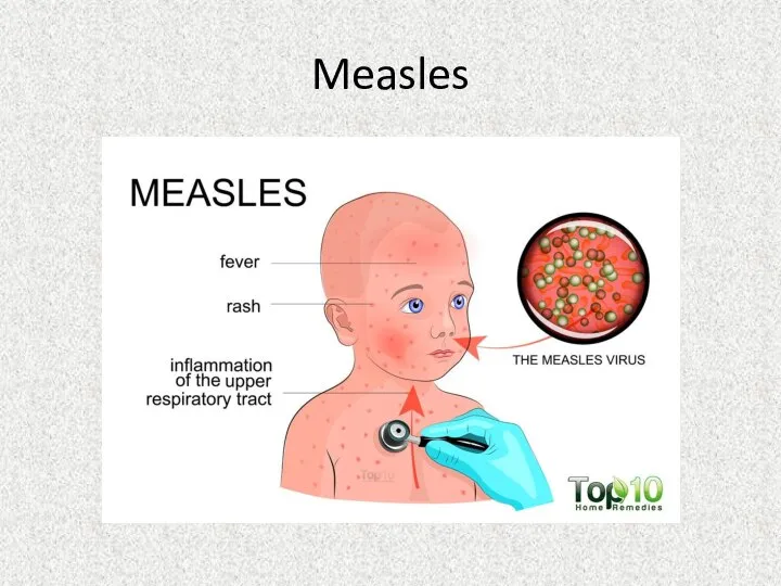 Measles