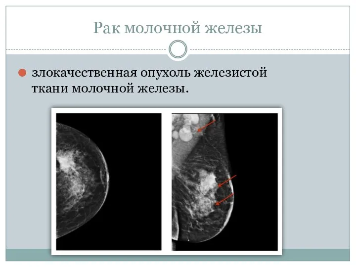 Рак молочной железы злокачественная опухоль железистой ткани молочной железы.