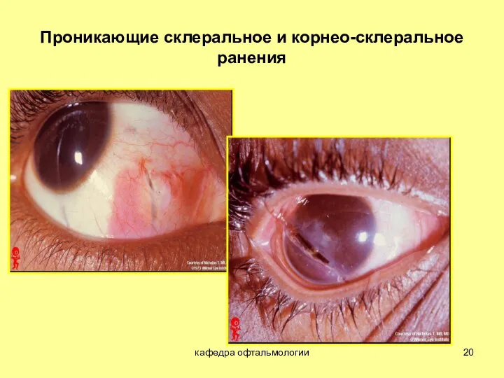 кафедра офтальмологии Проникающие склеральное и корнео-склеральное ранения