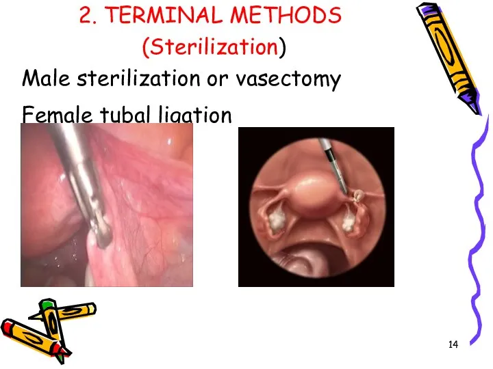 2. TERMINAL METHODS (Sterilization) Male sterilization or vasectomy Female tubal ligation