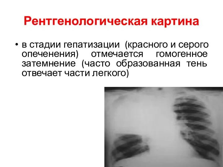 Рентгенологическая картина в стадии гепатизации (красного и серого опеченения) отмечается гомогенное затемнение