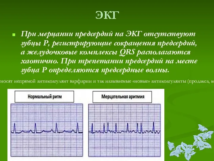 ЭКГ При мерцании предсердий на ЭКГ отсутствуют зубцы Р, регистрирующие сокращения предсердий,