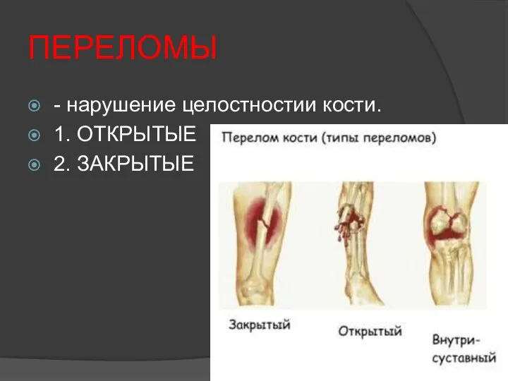 ПЕРЕЛОМЫ - нарушение целостностии кости. 1. ОТКРЫТЫЕ 2. ЗАКРЫТЫЕ