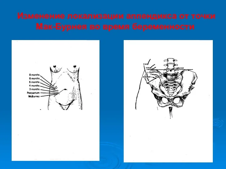 Изменение локализации аппендикса от точки Мак-Бурнея во время беременности