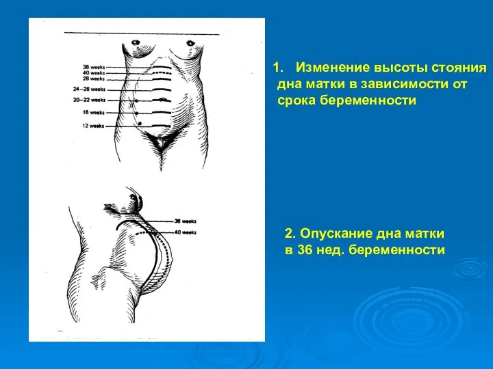 Изменение высоты стояния дна матки в зависимости от срока беременности 2. Опускание