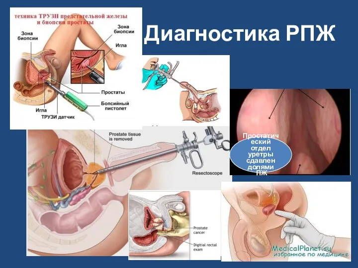 Диагностика РПЖ Простатический отдел уретры сдавлен долями ПЖ