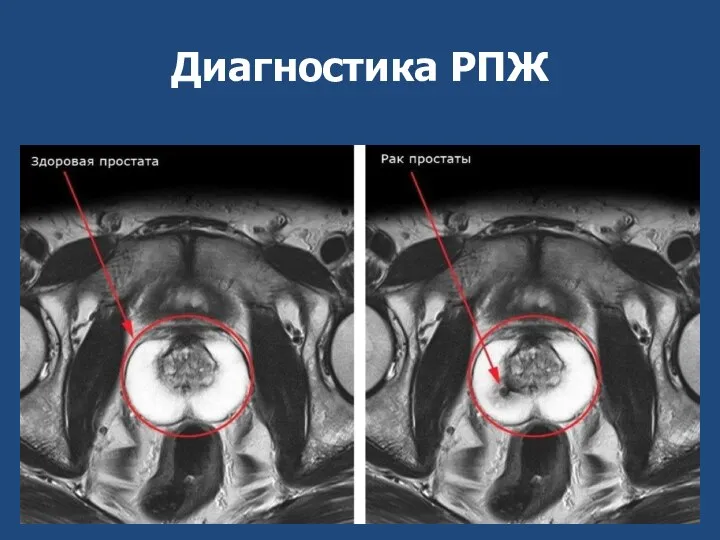 Диагностика РПЖ