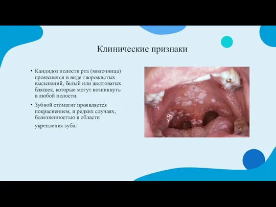 Клинические признаки Кандидоз полости рта (молочница) проявляется в виде творожистых высыпаний, белый