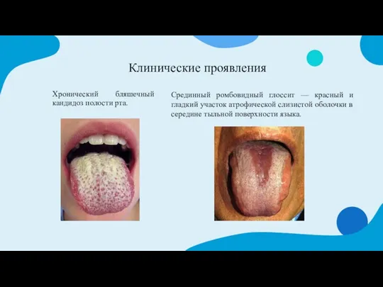Клинические проявления Хронический бляшечный кандидоз полости рта. Срединный ромбовидный глоссит — красный