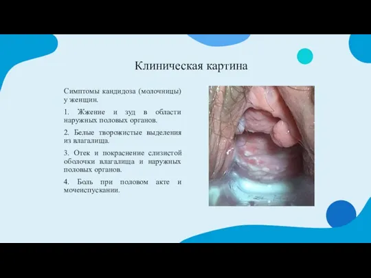 Клиническая картина Симптомы кандидоза (молочницы) у женщин. 1. Жжение и зуд в