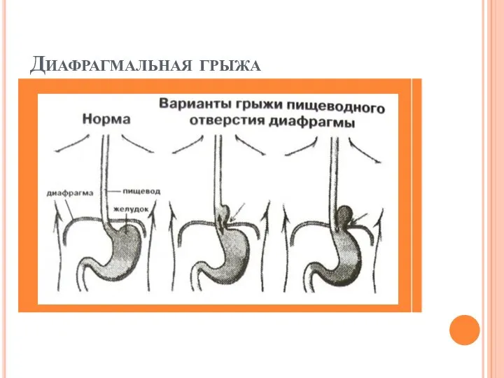 Диафрагмальная грыжа