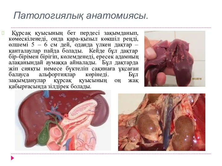 Патологиялық анатомиясы. Құрсақ қуысының бет пердесі зақымданып, көмескіленеді, онда қара-қызыл көкшіл реңді,