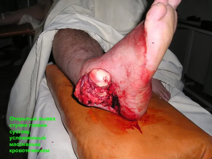 Открытый вывих ступни голени суставу, усложненный массивным кровотечением
