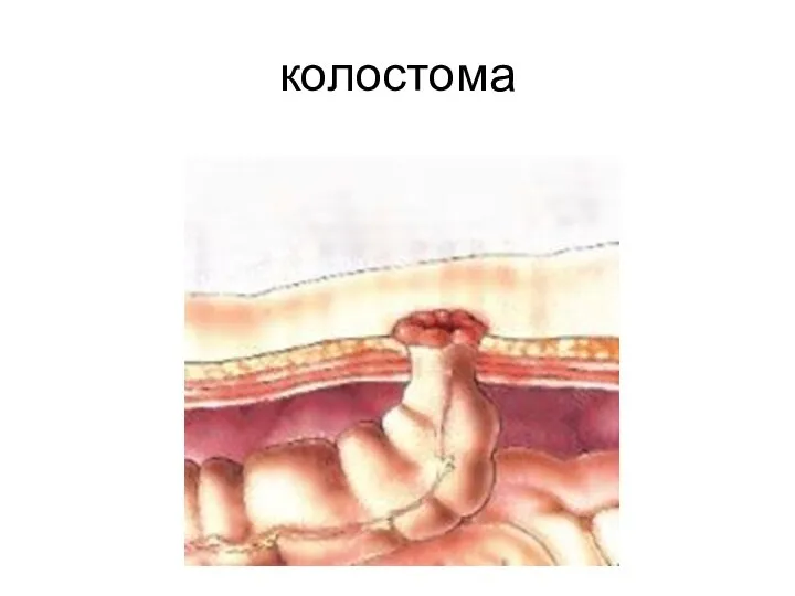 колостома