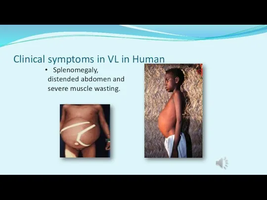 Clinical symptoms in VL in Human Splenomegaly, distended abdomen and severe muscle wasting.