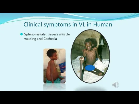 Clinical symptoms in VL in Human Splenomegaly , severe muscle wasting and Cachexia